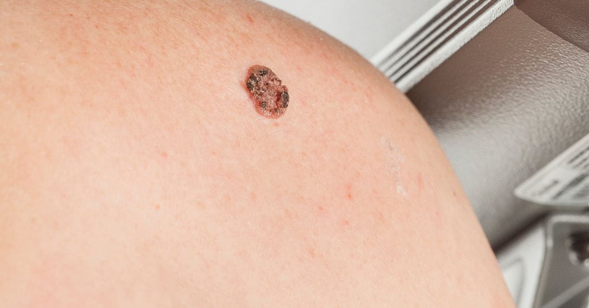 carcinoma